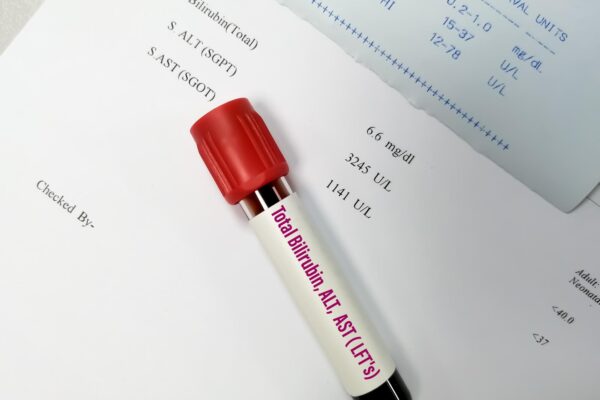 TGO și TGP mărite: ce pot arăta despre sănătatea ficatului
